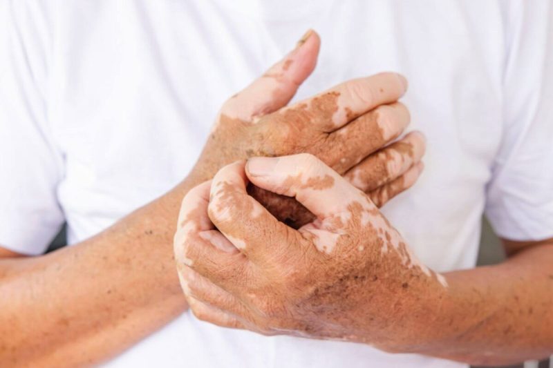 Όσα πρέπει να γνωρίζετε για την Λεύκη